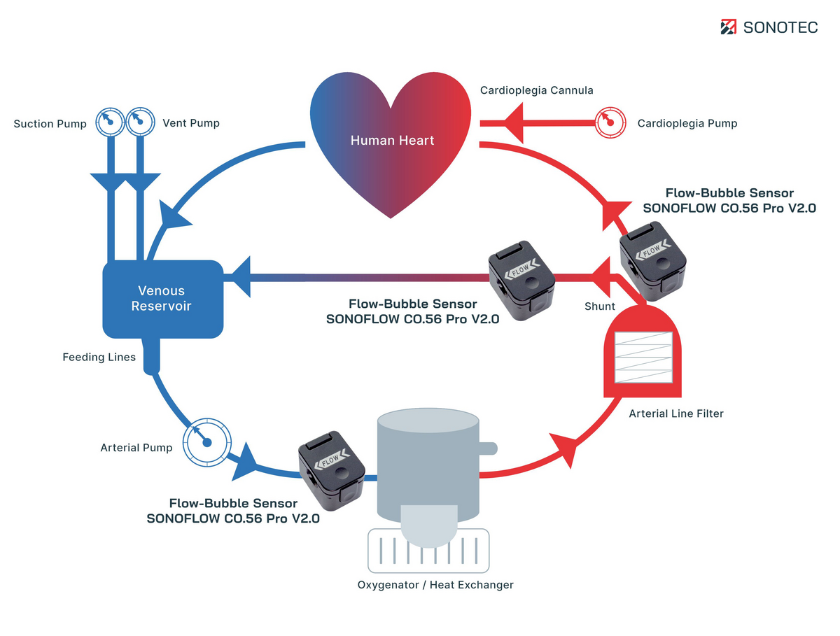 Illustration Heart Lung Machine with Flow-Bubble Sensors - © SONOTEC GmbH 
